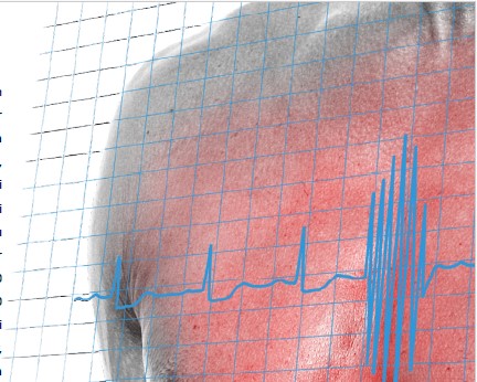 Günde 8 Kutu Enerji İçeceği: İnme ile Sonuçlanan Bir Olgu